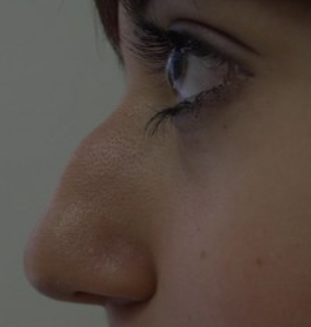 جراحی زیبایی بینی گوشتی و استخوانی و تفاوت های آنها